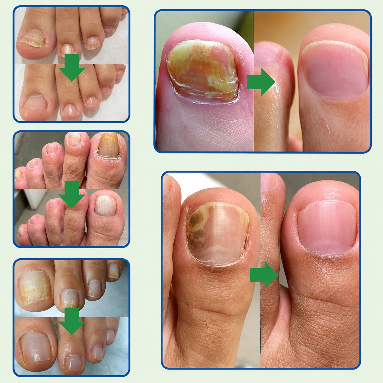 TRATAMIENTO ANTIHONGOS PARA UÑAS 100% NATURAL